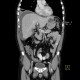 Perforation of peptic ulcer: CT - Computed tomography